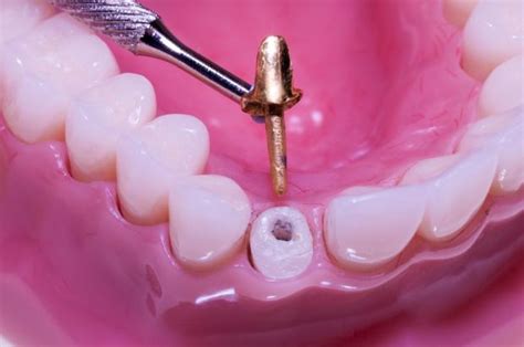 crown metal fabrications|post crown dental.